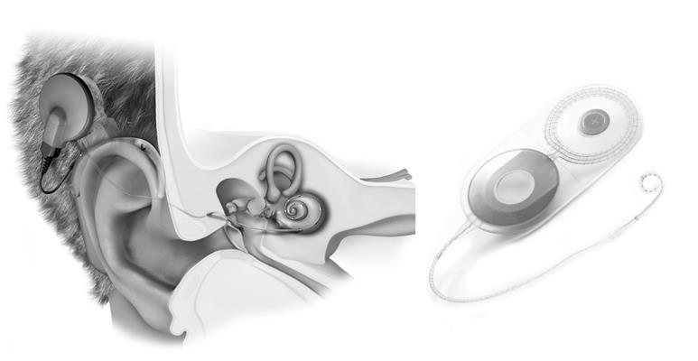 Inwendig deel van een cochleair implantaat